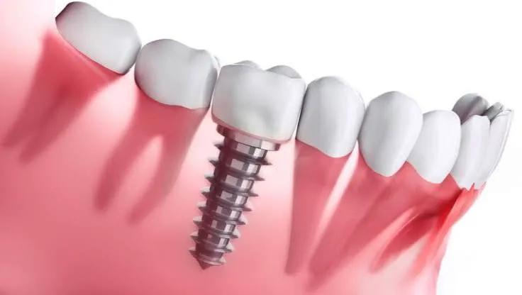 Can Dental Implants Prevent Other Teeth